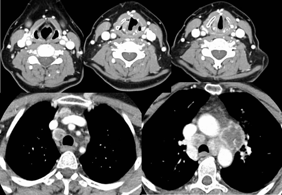 lung-cancer-vc-paralysis